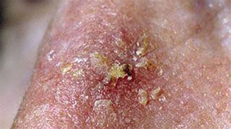 Skin Cancer Rash Itchiness And Symptoms