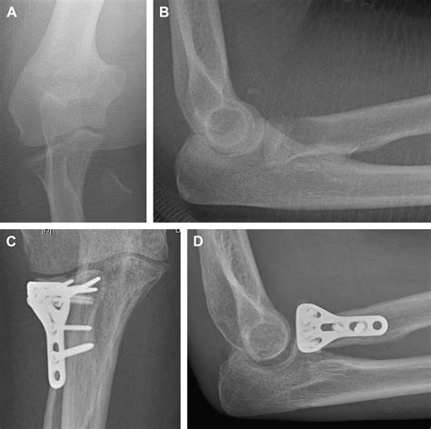 Current Recommendations For The Treatment Of Radial Head Fractures Orthopedic Clinics