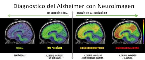 La Neuroimagen Para Detectar El Alzheimer Blog Imentia