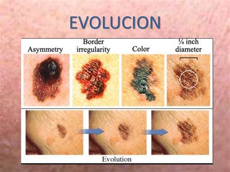 Tipos De Melanomas