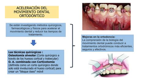 MOVIMIENTO DENTAL EN ORTODONCIA Revision De Articulo Cientifico PPT