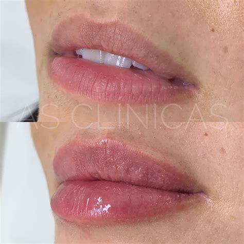 Preenchimento Labial Caso 6 AS Clínicas