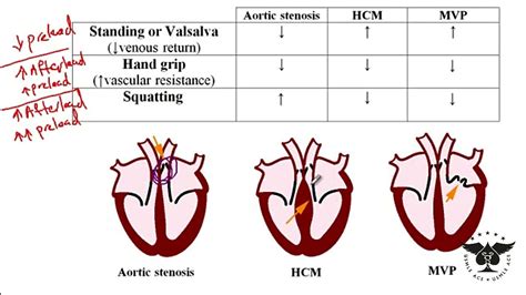 Aortic Stenosis Murmur