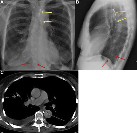 A Postero Anterior Chest Radiograph And B Lateral Radiograph Note