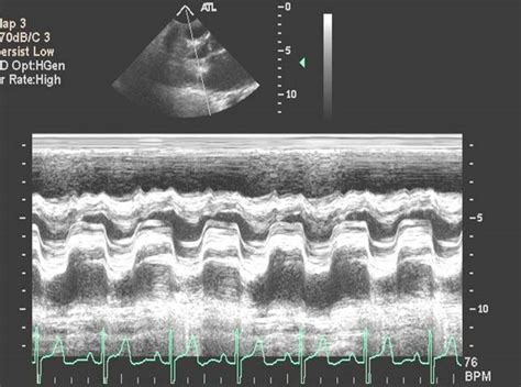 Mitral stenosis echocardiography - wikidoc