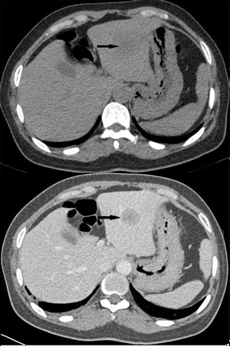 Ct Of Abdomen Without Contrast