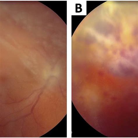 1A: At presentation, exam showed 360° of ciliary flush and a 5 × 6 mm ...