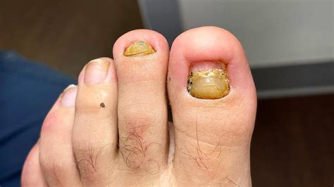 Removing Toenails With Fungus Do Not Try This At Home Youtube