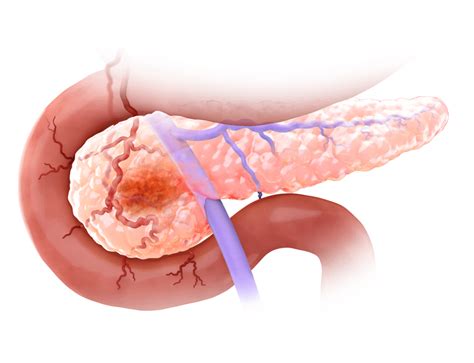 Pancreatic Ductal Adenocarcinoma Treatment Approach