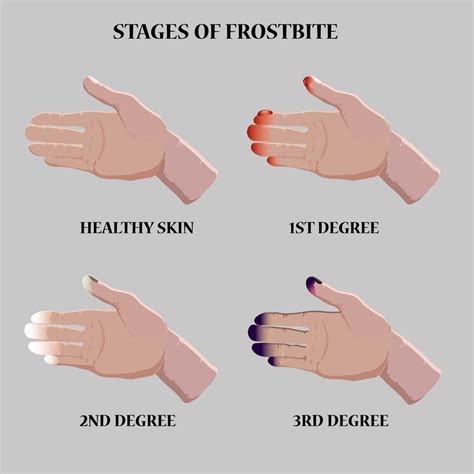 Medical Vector Illustration Frostbite Stages Blue And Red Frostbitten