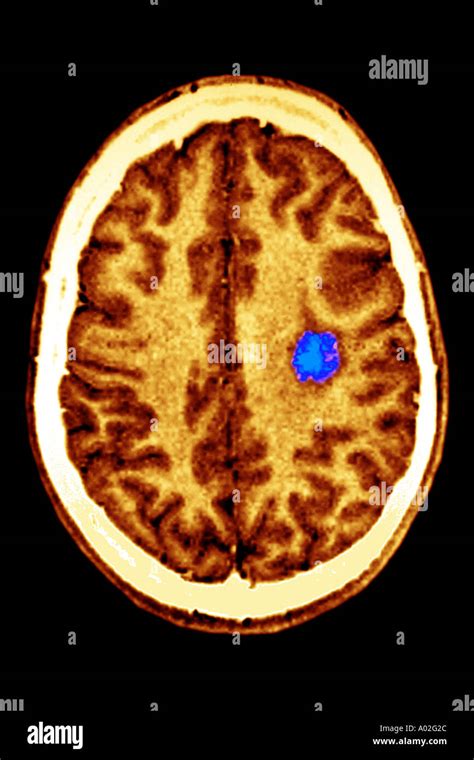 Brain Tumor Scan Hi Res Stock Photography And Images Alamy