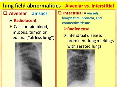 Interstitial Vs Alveolar Pattern