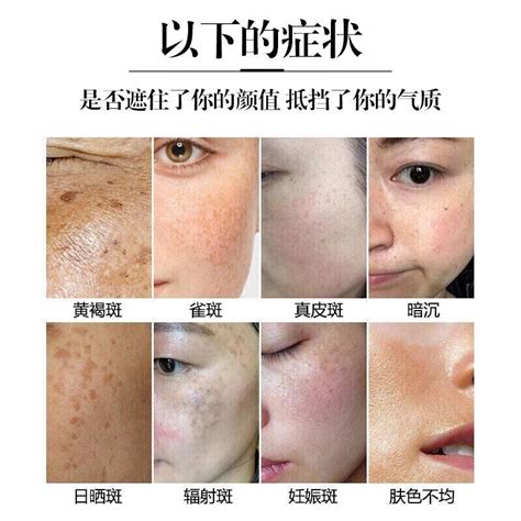 晒斑真的可以通过手术去除吗？ 晒斑 淘宝百科网