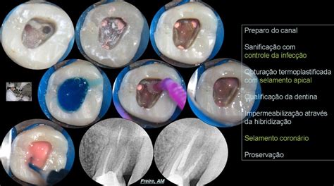 Tratamentos Ângelo Freire Endodontia Microscópica Clínica e Cirúrgica