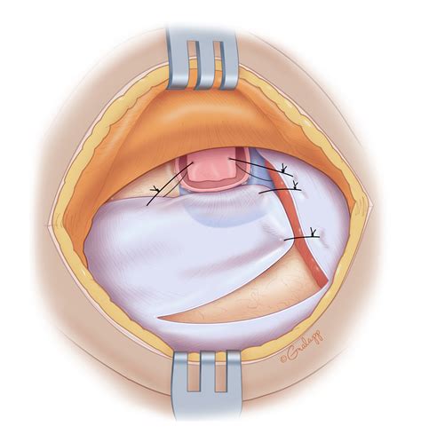 Mastoid Obliteration Oto Surgery Atlas