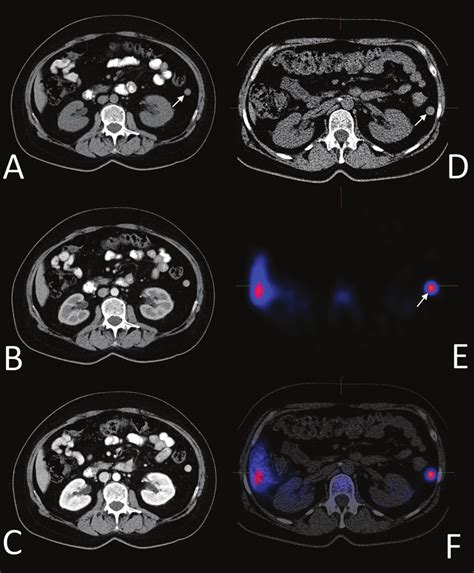 Patient A B C Multi Phase Computed Tomography Ct Pre Contrast