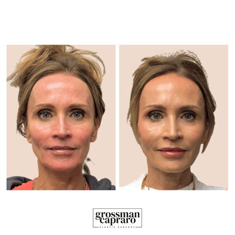 Renuva Grossman Capraro Plastic Surgery