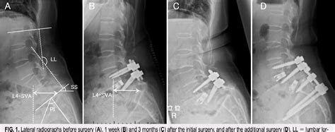 Figure 1 From Bilateral L5 Pedicle Fracture With L5 S1