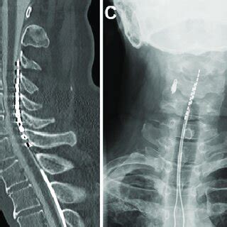 Cervical Radiography CT Myelography Sagittal And Axial View SCS