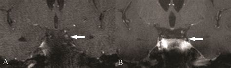 6th Nerve Palsy Mri