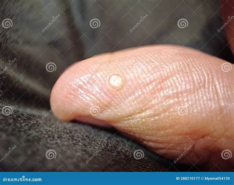 Zoomed In View The Intricacies Of A Distinct Thumb Wart Stock Image