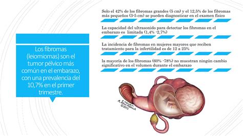 Miomas Uterinos Y El Embarazo Ppt