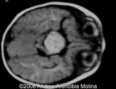 Congenital Hypothalamic Hamartoma Syndrome