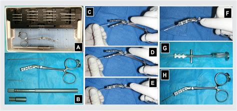 Figure 1 from Arthrodesis of the First Metatarsal–Phalangeal Joint With Titanium Flexible ...