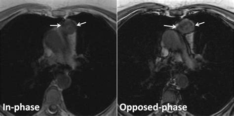 Thymoma In A 65 Year Old Woman With Myasthenia Gravis Transverse