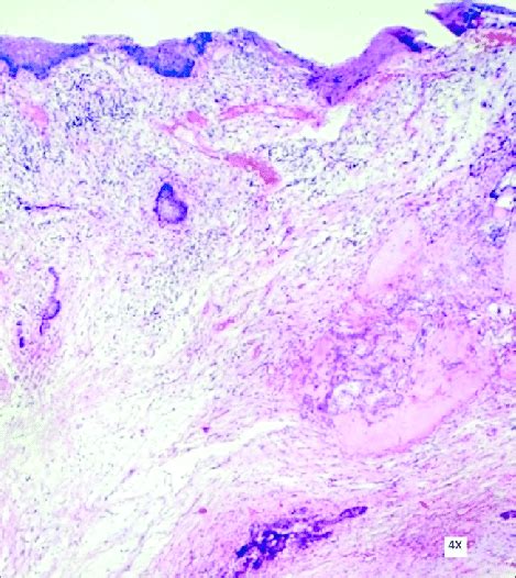 Photomicrograph Showing Surface Epithelium And Fibrocellular Stroma