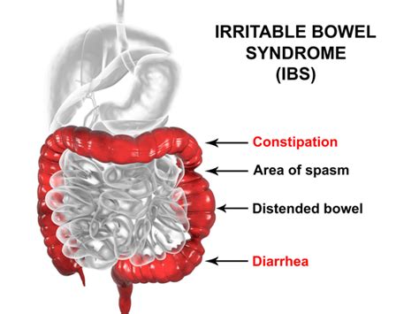 Irritable Bowel Syndrome - Dr Bansal & Associates