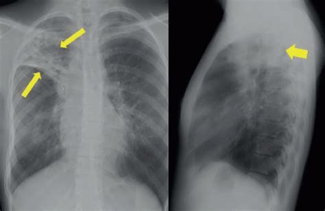 Post-Primary Tuberculosis | Radiology Key