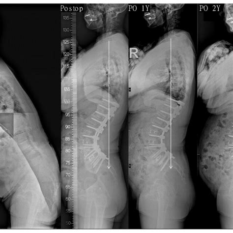 This 67 Year Old Female Presented To Us With Degenerative Sagittal