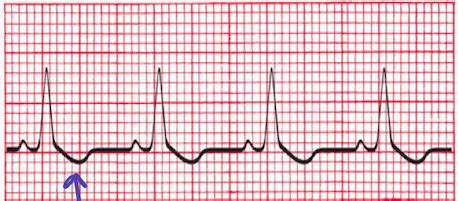 Diagnostic Exam 2 EKGs Flashcards Quizlet