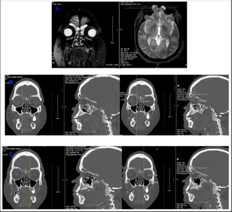 A Magnetic Resonant Imaging Mri That Shows Fluid Signals In The