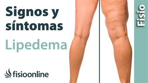 SIGNOS y SÍNTOMAS para el DIAGNÓSTICO del LIPEDEMA YouTube