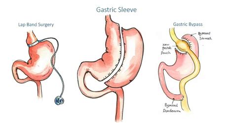 Gastric Sleeve Surgery: Benefits, Risks & Costs » How To Relief