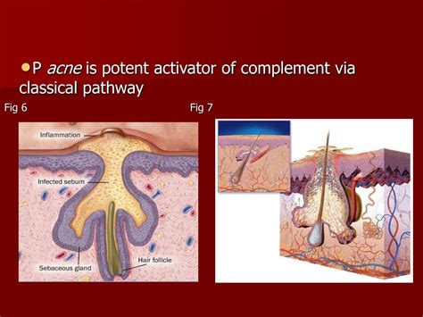 Ppt Acne Disorders Of Sebaceous Gland Powerpoint Presentation Free Download Id9577232