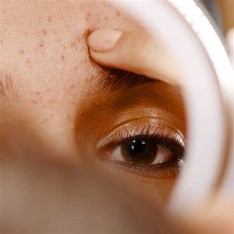 Best Acne Treatments How To Identify Every Kind Of Acne Allure