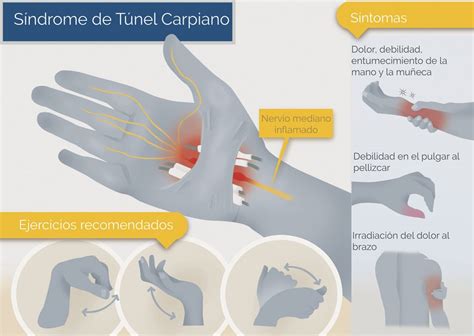 S Ndrome Del T Nel Carpiano A Qu Profesionales Afecta M S