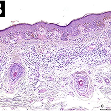 Histopathological Analysis Showing Mild Peritumoral Inflammatory