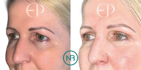 Eyelid Lift Surgery Blepharoplasty North Bristol Private Hospital