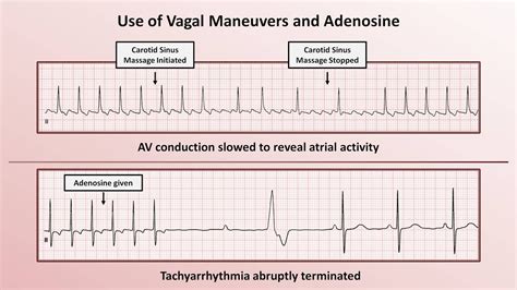 Intro To Ekg Interpretation How To Identify Any Tachyarrhythmia With