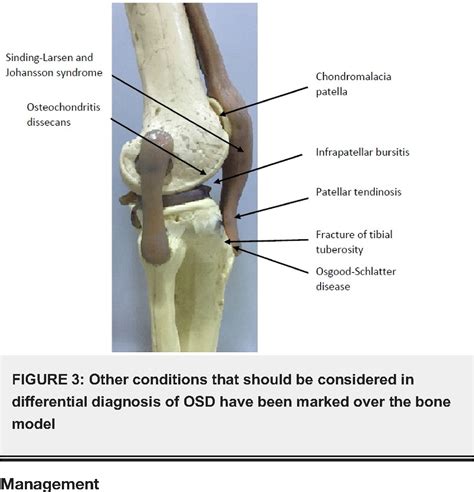 Tibial Tuberosity Surface Anatomy