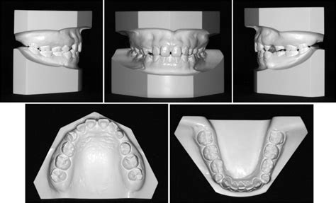 Interdisciplinary treatment of a nonsyndromic oligodontia patient with implant-anchored ...