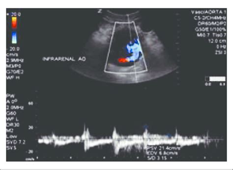 Duplex Sonography With Spectral Doppler Demonstrating Flow Outside The Download Scientific