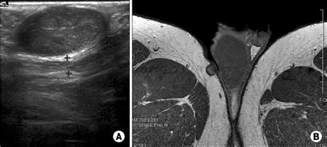 Figure 2 From Multiple Epidermoid Cysts Arising From The