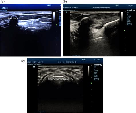 Ultrasound Guided Sln Block And Transtracheal Injection Note A The