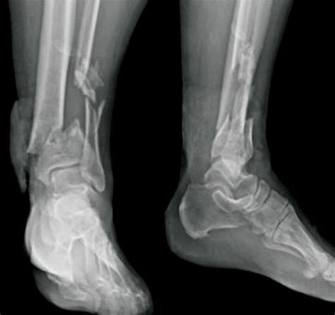 Preoperative Radiological Characteristics Of A Pilon Fracture