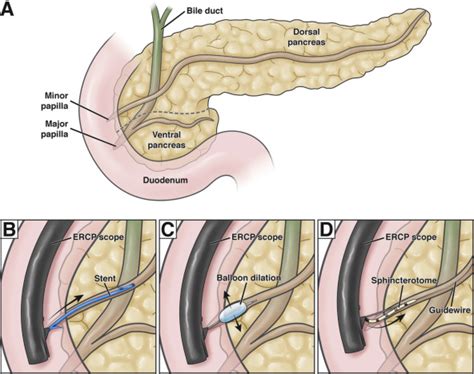 Chronic Pancreatitis Ercp